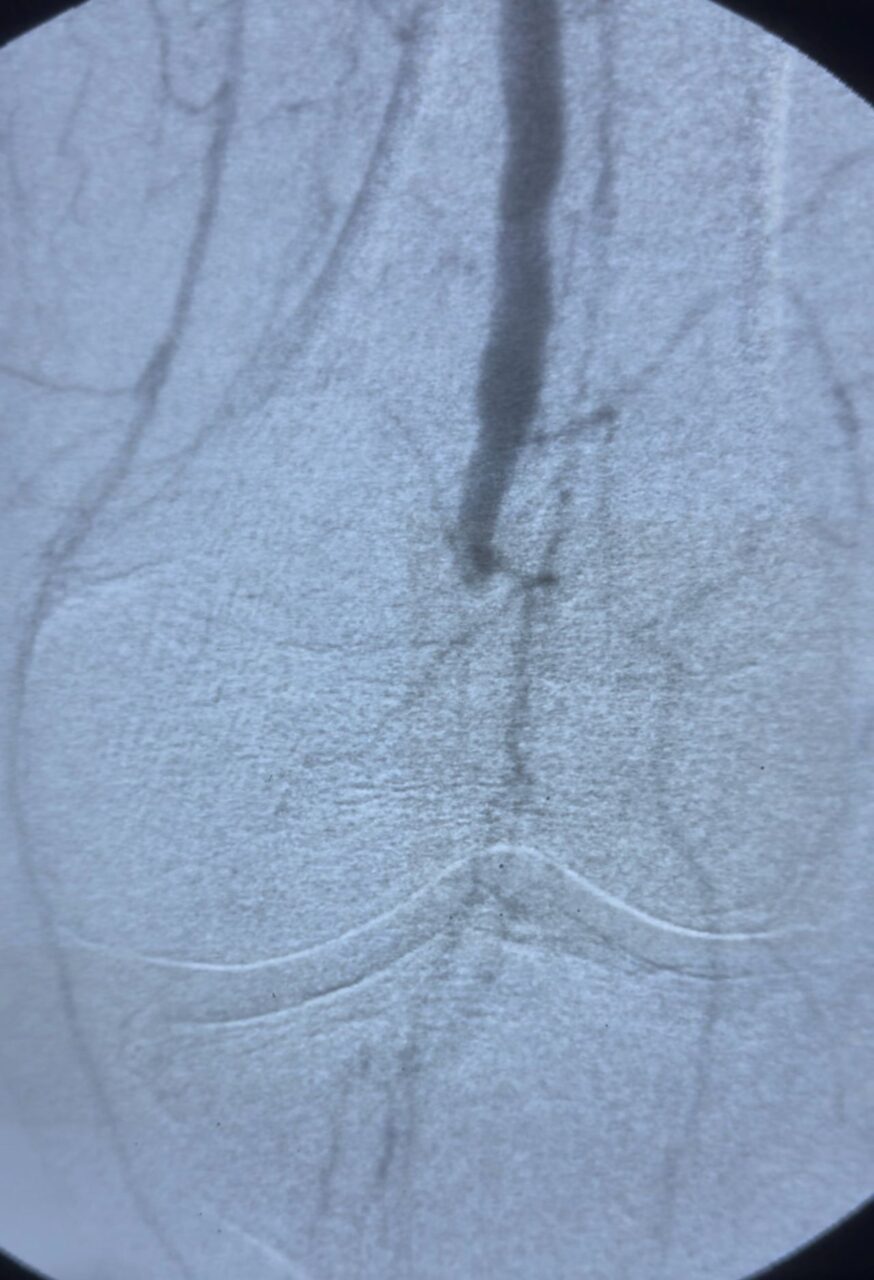 Carlos Rodríguez Shares a Complex Case of Combined Antegrade–Retrograde Thrombectomy
