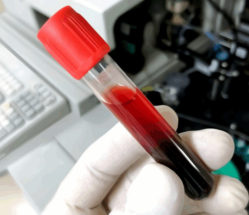 Hemolyzed Samples