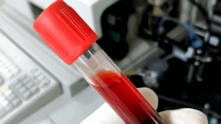 The Effect of Hemolyzed Samples on Laboratory Test Results