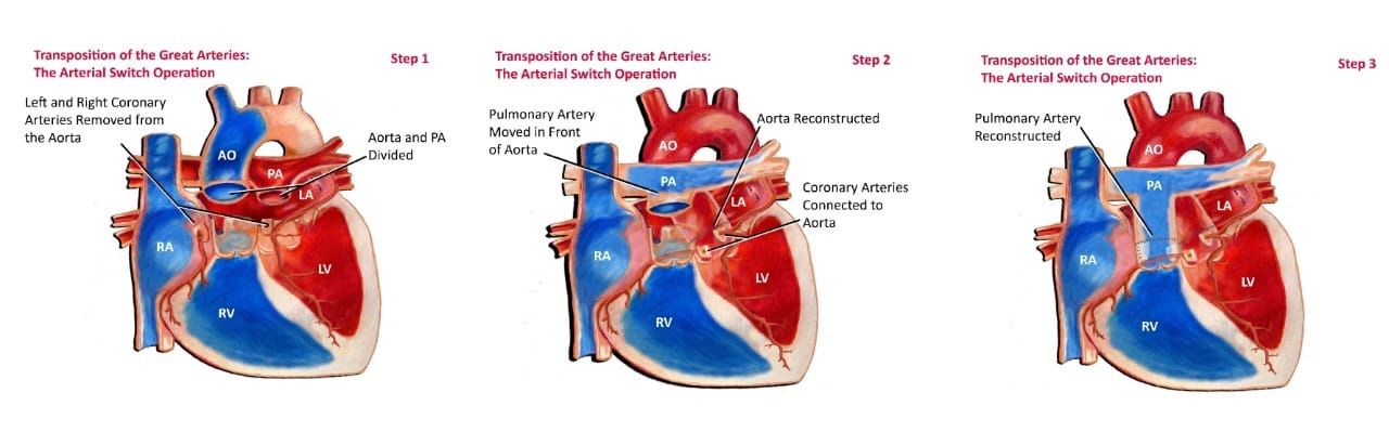 Thirulogachandar S — Understanding the Atrial Switch Operation: Senning and Mustard Procedures Explained 1 Thirulogachandar S — Understanding the Atrial Switch Operation: Senning and Mustard Procedures Explained