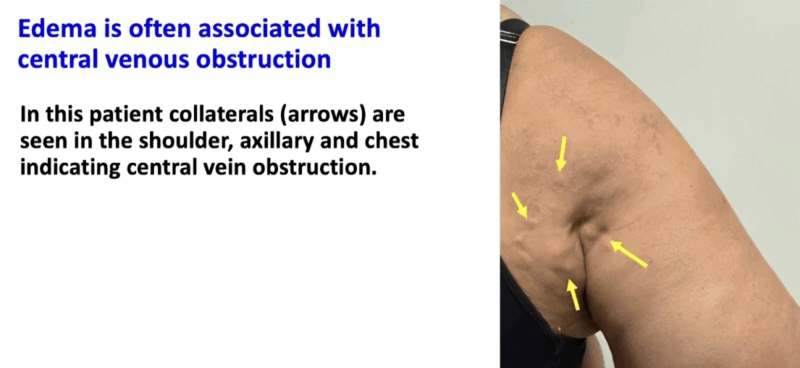 Thrombosis