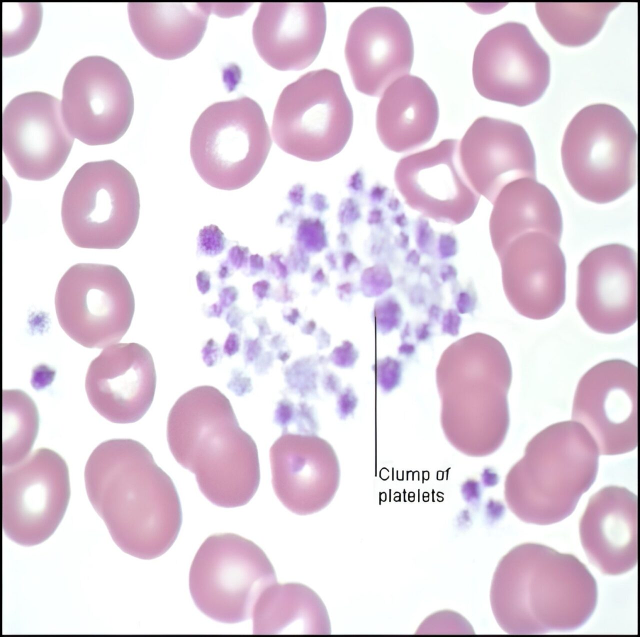 Asmaa A About Pseudo Thrombocytopenia: Causes and How to Handle 