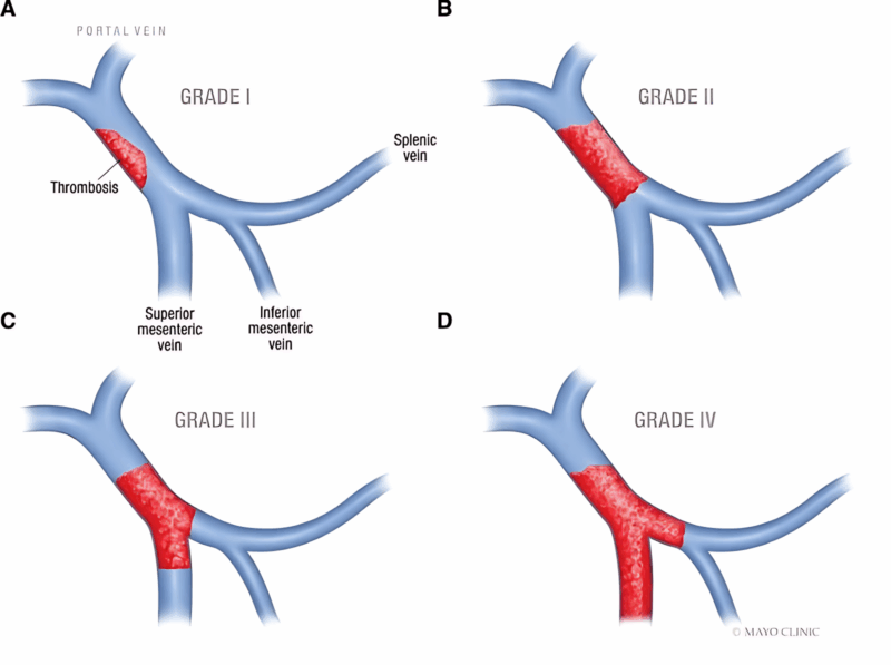 Liver Transplantation