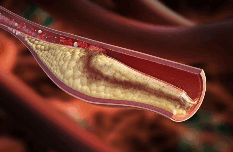 Mahesan Subramaniam: Microplastics in Arteries Quadruple Risk of Heart Attack and Stroke 1 Mahesan Subramaniam