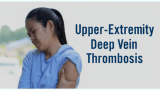 World Thrombosis Day: Early Detection of Upper Limb Thrombosis Saves Lives
