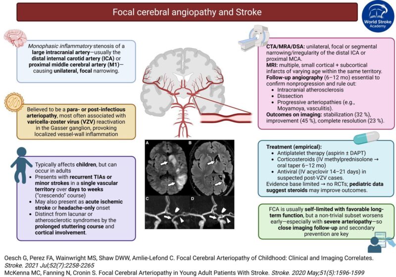 Stroke Education By Rodrigo Guerrero - On Unilateral, Nonprogressive Stenosis