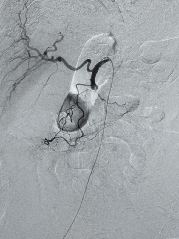 Luca Joel De Simone Demonstrates Complete SMA Recanalization Using Urokinase and Thromboaspiration with Penumbra