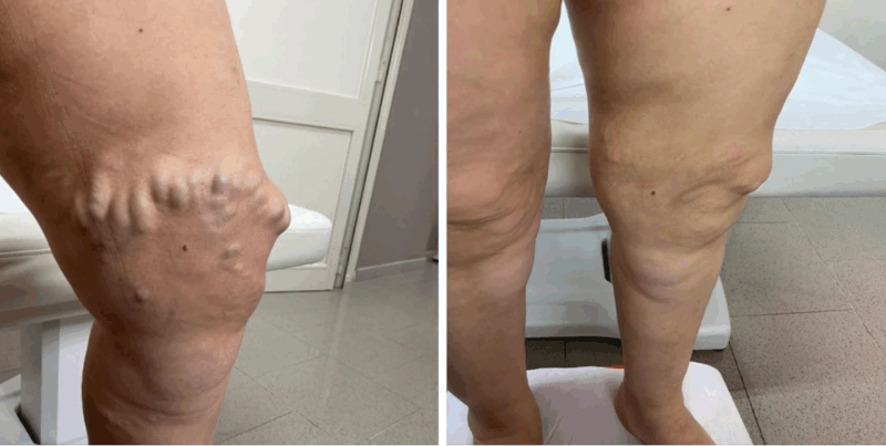 Revisiting Foam Sclerotherapy: Challenging the 7 mm Dogma 1 Sclerotherapy