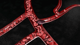 ImmuneLink LLC Research: Role of Interferon-Gamma (IFN-γ) in Pathophysiology and Management of Deep Vein Thrombosis