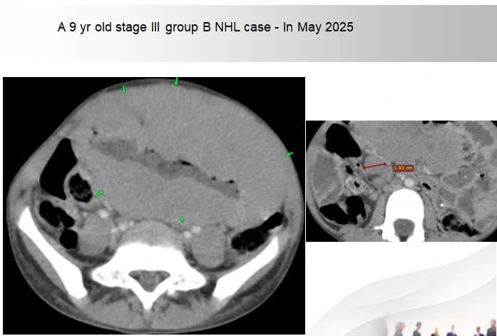 Gashaw Arega: Golden September – Childhood Cancer Awareness Month 1 Gashaw Arega: Golden September – Childhood Cancer Awareness Month