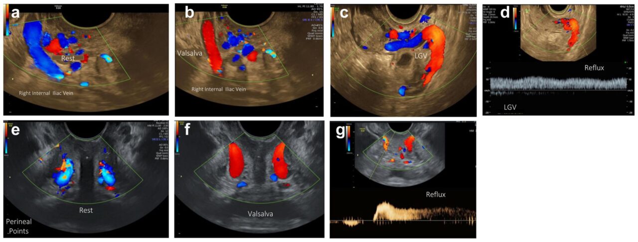 Jan Sloves Highlights New Protocol Making Transvaginal Ultrasound a Game-Changer for PeVD