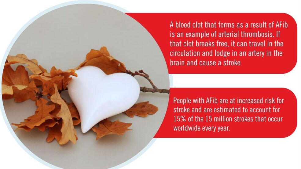 Atrial Fibrillation Increases the Risk of Stroke by Up to Fivefold Due to Clot Formation in the Atria
