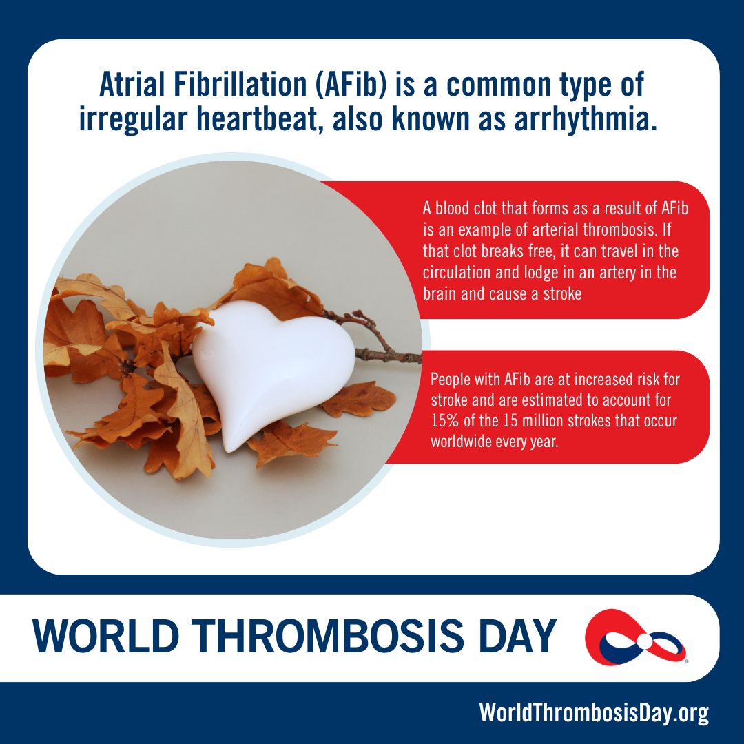 Atrial Fibrillation Increases the Risk of Stroke by Up to Fivefold Due to Clot Formation in the Atria
