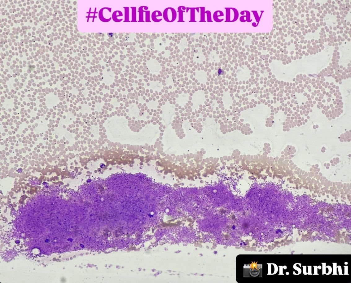Surbhi Singh: Platelet Clumps — The Culprit Behind Pseudothrombocytopenia