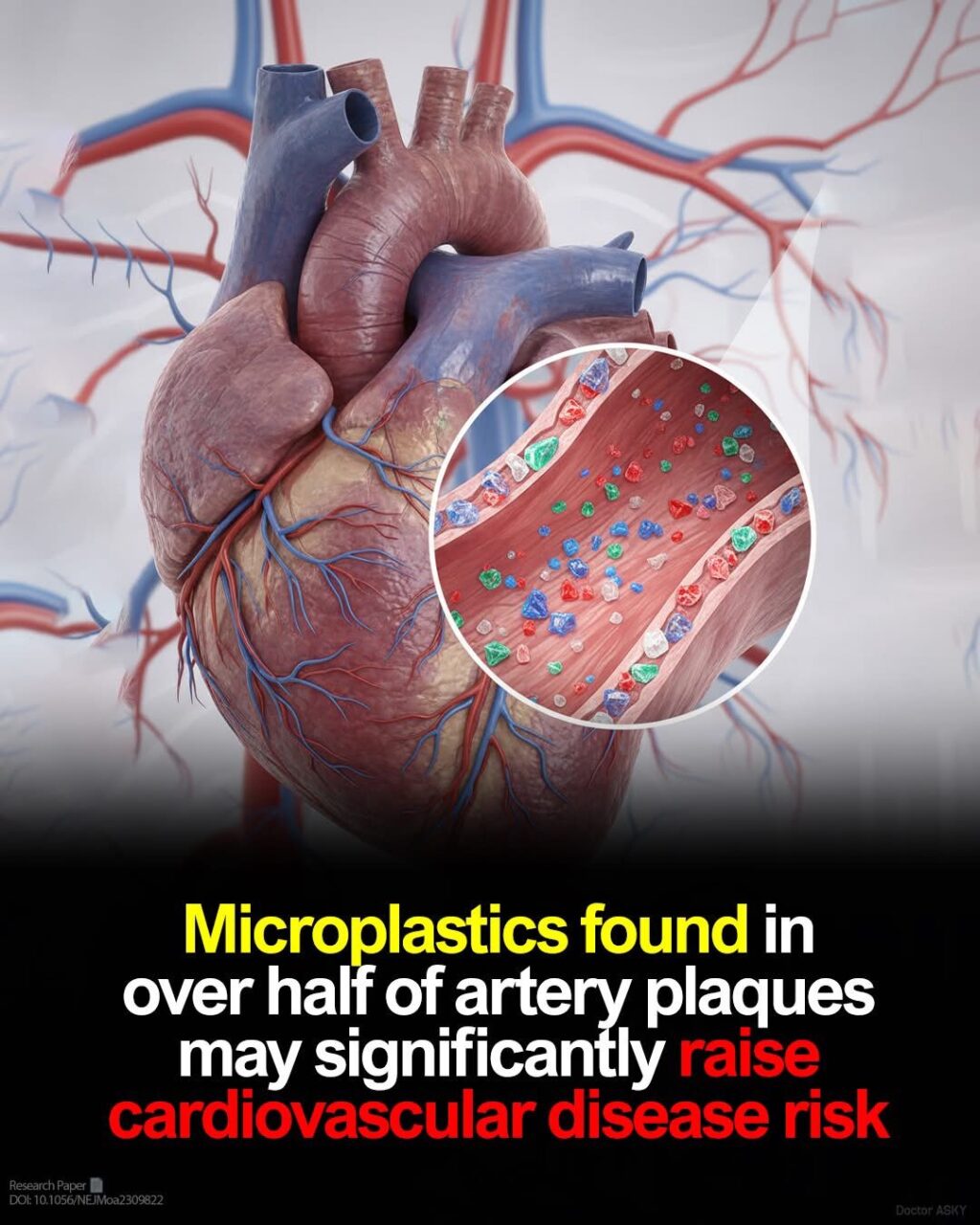 Mahesan Subramaniam: Microplastics - Present in More Than 50% of Arterial Plaques Removed During Surgery