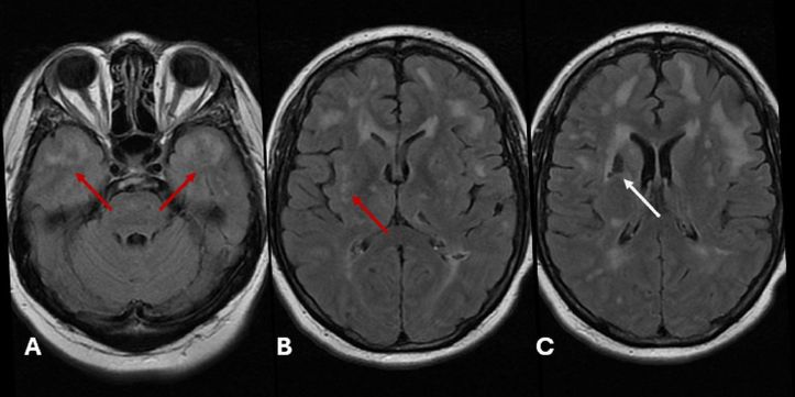 Leonardo Furtado Freitas on CADASIL: Early Diagnosis Equals Better Management