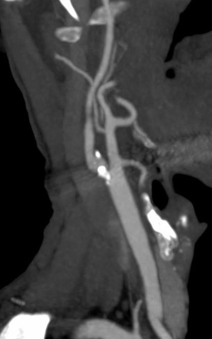 Péter Pál Böjti on CREST-2 Trial: Does Carotid Revascularisation Still Matter?