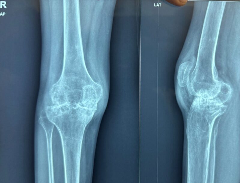 Amol Kadu on Joint Replacement Techniques in Hemophilia Arthropathy 1 Amol Kadu on Joint Replacement Techniques in Hemophilia Arthropathy