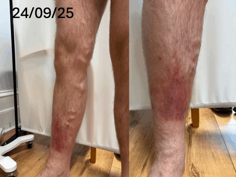 Alastair Lewis: Powerful TIRS Outcomes in Venous Ulcer Prevention