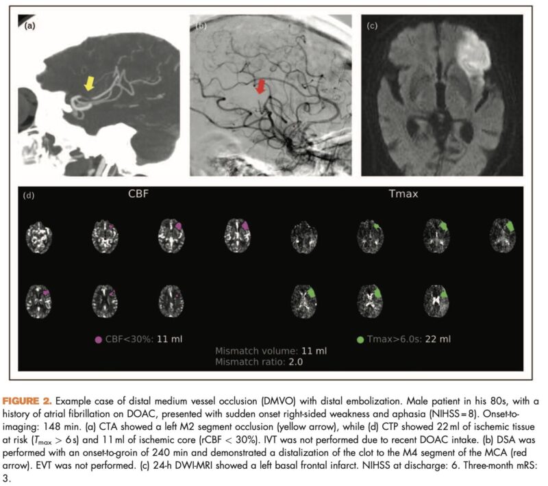 New Insights from Antonio Ciacciarelli on Endovascular Treatment for Medium and Distal Vessel Occlusions