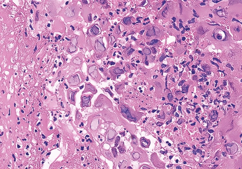 Nihar Desai: Post-Transplant Dysphagia 1 Nihar Desai