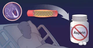 NEJM Quick Take: Is Early Aspirin Withdrawal Safe After PCI?