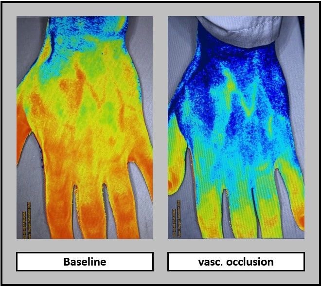 The 1st Participant in A New CHECK-NIRS Clinical Study is Enrolled!