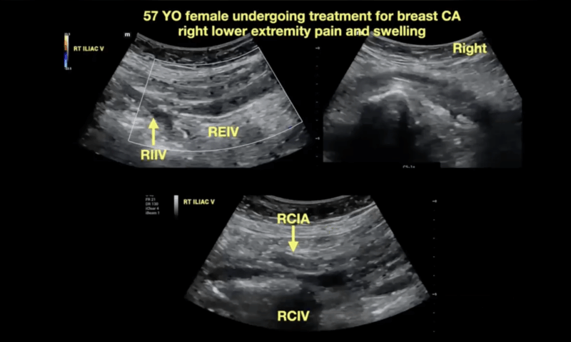 Jan Sloves: Understanding Iliofemoral DVT - What You Can’t Afford to Miss