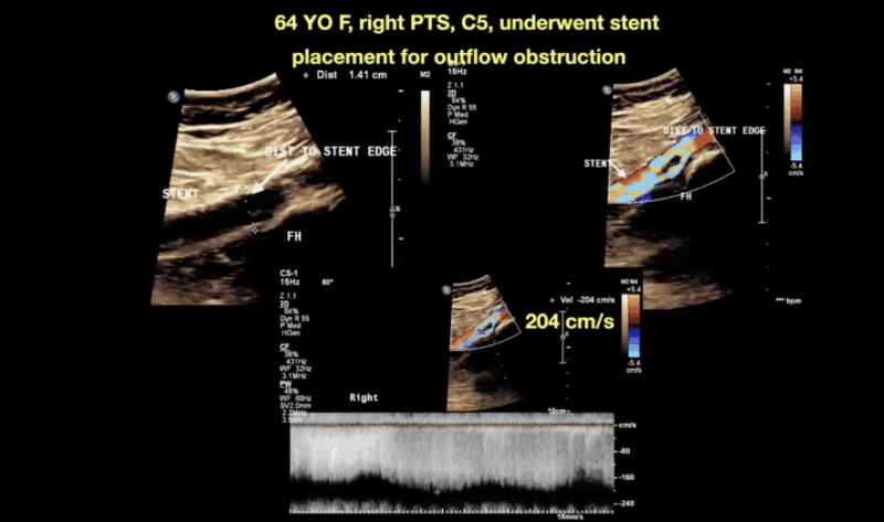 Jan Sloves: When Stent Placement Misses the Mark - A Lesson in Precision and Follow-Up
