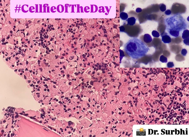 Cellfie of the Day: Classic Gaucher Cells Under the Microscope 1 Gaucher cells