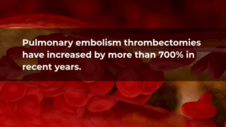 Thrombectomy Rates Rise 700% Nationwide
