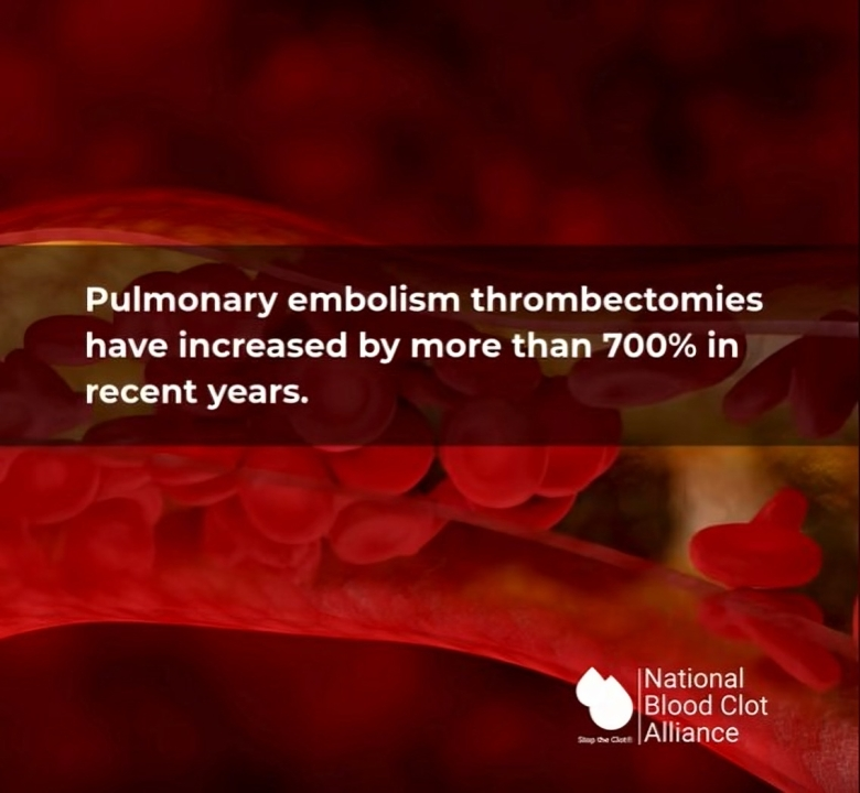 Thrombectomy