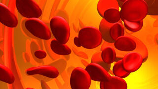 Can AI Predict Thrombotic Recurrence in Antiphospholipid Syndrome?