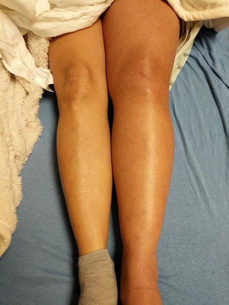 Jonathan Douxfils on a Dangerous Misconception: Why Factor V Leiden + the Pill Is a Major Problem