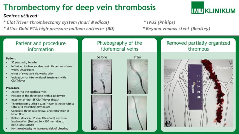 Mohammad E Barbati on ClotTriever System for Postpartum Iliofemoral DVT