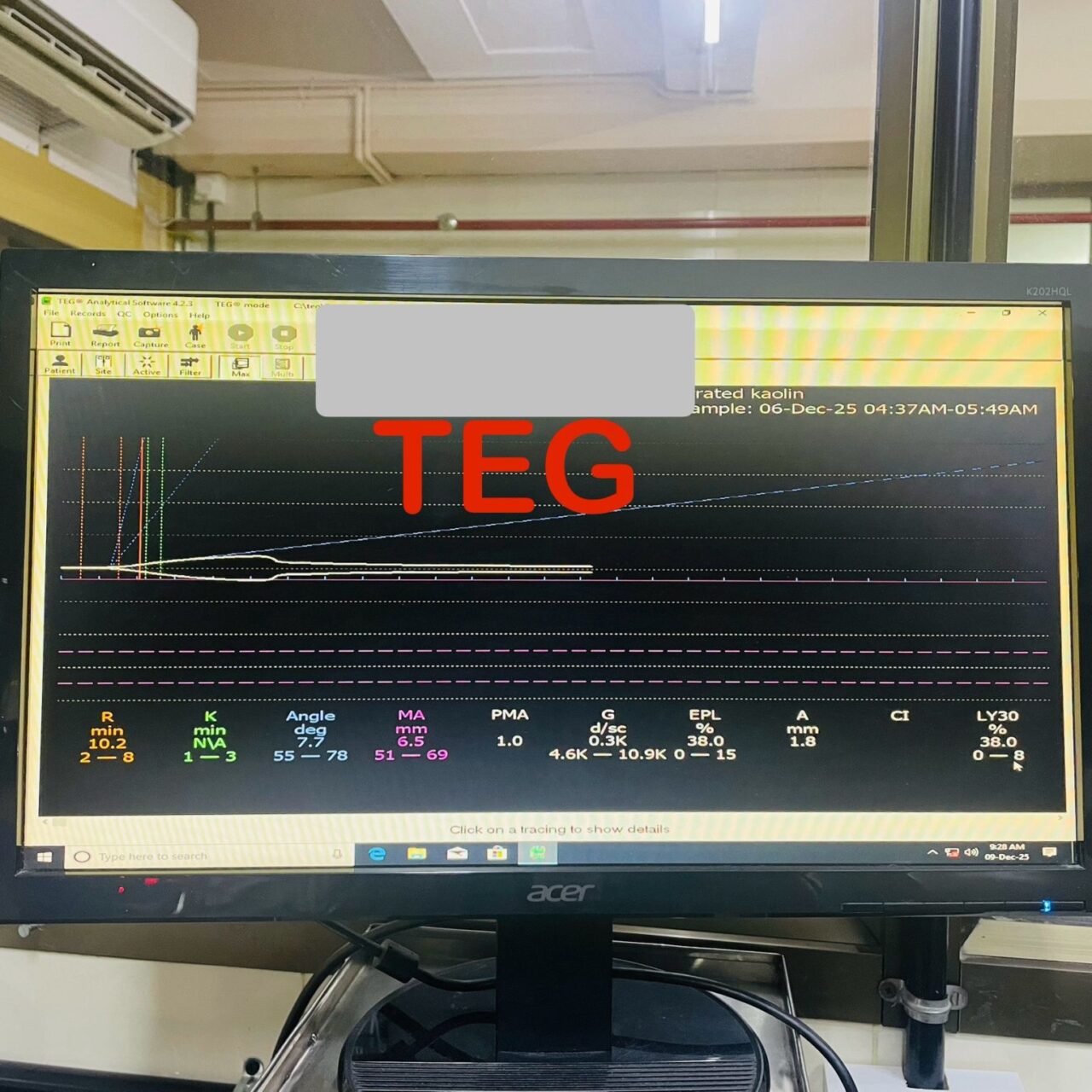 Priya Prasad: A Night in the ER - When a Snakebite Teaches You the Power of Viscoelastic Testing 1 Priya Prasad: A Night in the ER - When a Snakebite Teaches You the Power of Viscoelastic Testing