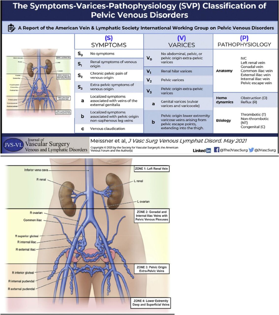 Heghine Khachatryan about PVCS as Cause of Chronic Pelvic Pain and Lower-Extremity/Pelvic Varices in Women 1 Heghine Khachatryan about PVCS as Cause of Chronic Pelvic Pain and Lower-Extremity/Pelvic Varices in Women
