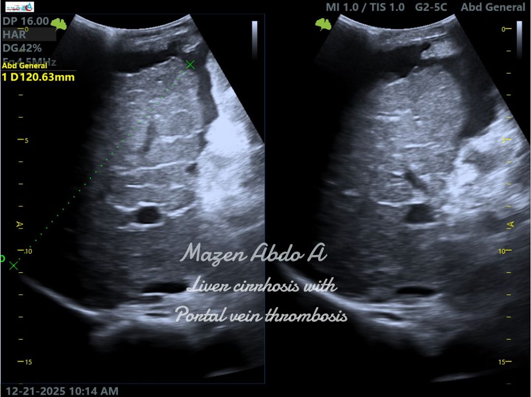 Mazen Abdo A Y. Shares Ultrasound Case from Daily Practice: Liver Cirrhosis with PVT 1 Mazen Abdo A Y. Shares Ultrasound Case from Daily Practice: Liver Cirrhosis with PVT