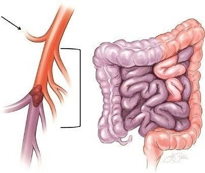 Muhammad Bilawal Khan Explains AMI: Severe Abdominal Pain That Looks "Simple" Can Be Deadly