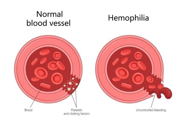 Balqees M Al Rafayah: What is Hemophilia?