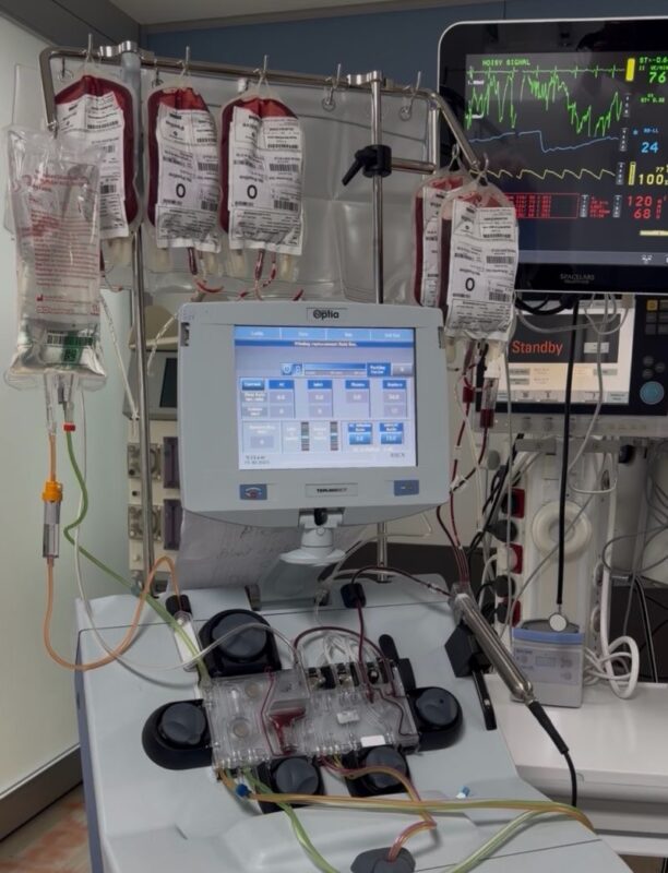 Ibtesam Alsufyani on RBC Exchange: A Life-Saving Apheresis Procedure 1 Ibtesam Alsufyani on RBC Exchange: A Life-Saving Apheresis Procedure