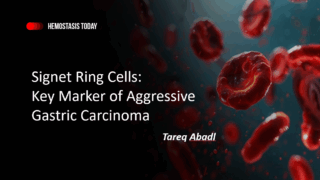 Signet Ring Cells Explained: Key Marker of Aggressive Gastric Carcinoma