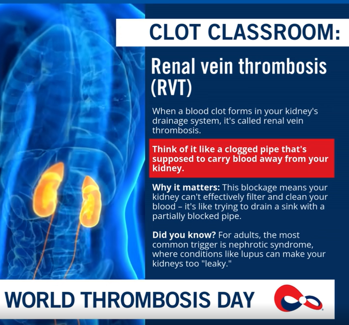 Clot Classroom: Renal Vein Thrombosis (RVT) - World Thrombosis Day 1 Clot Classroom: Renal Vein Thrombosis (RVT) - World Thrombosis Day