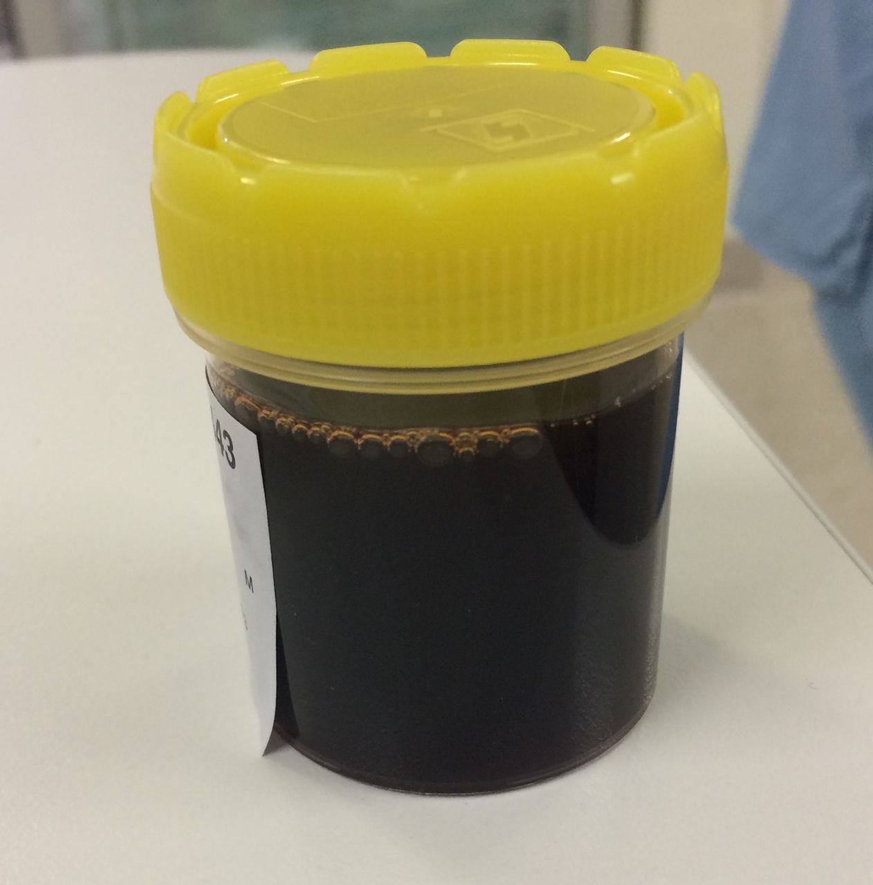 Case by Nico Gagelmann: Patient With Sickle Cell Disease... 1 Case by Nico Gagelmann: Patient With Sickle Cell Disease...