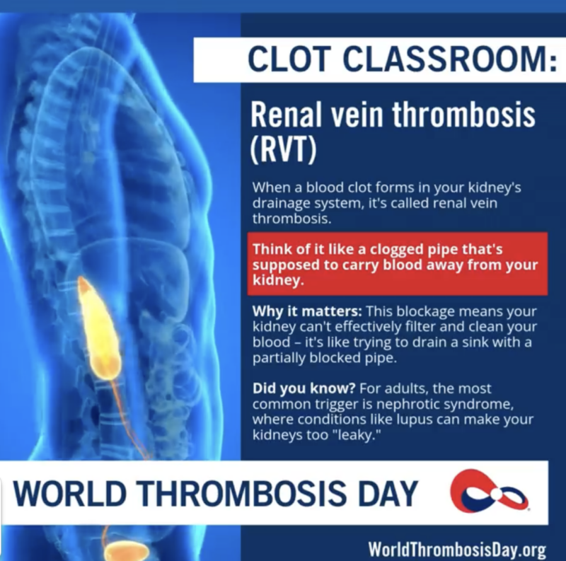 Important Reminder from Rick Matthews: Renal Vein Thrombosis Can Be Easy to Miss 1 Important Reminder from Rick Matthews: Renal Vein Thrombosis Can Be Easy to Miss