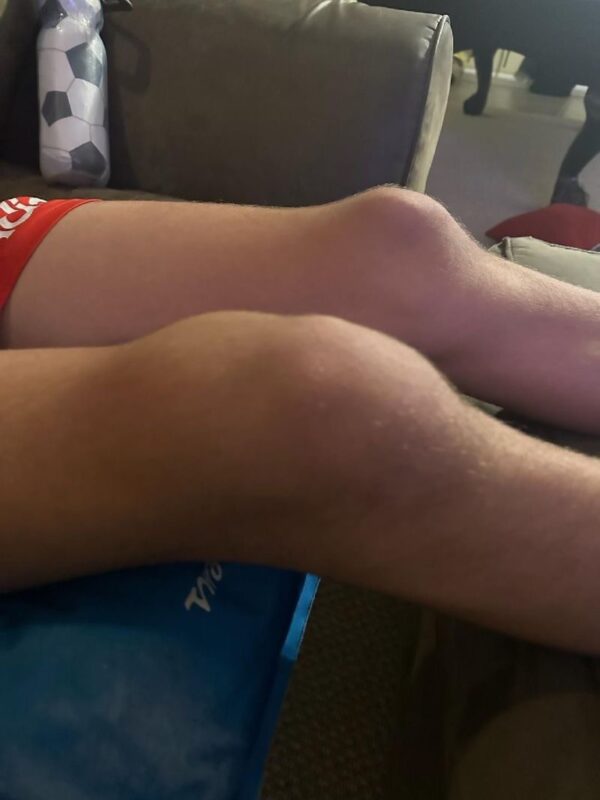 Rob Maloney: A Bruise that Did Not Go Away... 1 Rob Maloney: A Bruise that Did Not Go Away...