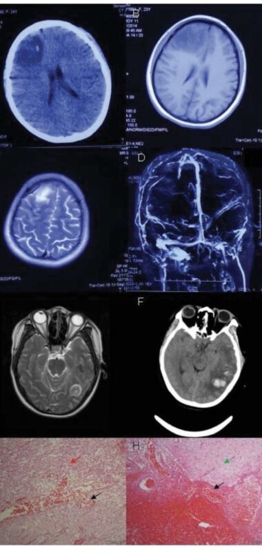 Babak Abdolkarimi on Post-Thrombotic Complications in Brain Tumor Patients