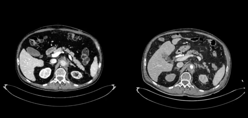 Marvin Garcia Reyes Presents a Case of Aorto-Visceral and Aorto-Iliac Thrombosis 1 Marvin Garcia Reyes Presents a Case of Aorto-Visceral and Aorto-Iliac Thrombosis