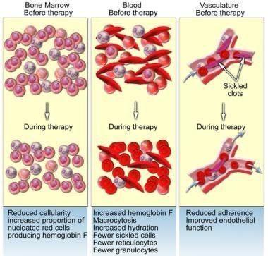 John Amako: Childhood to Adulthood Management Approach for SCD 1 John Amako: Childhood to Adulthood Management Approach for SCD