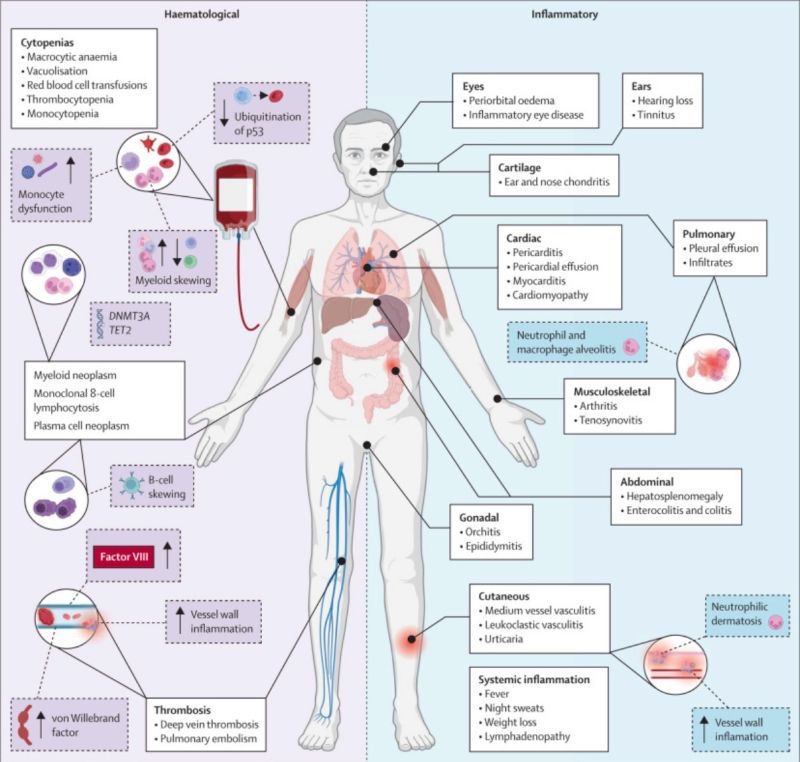 Emma Groarke Shares A Comprehensive Review on VEXAS Syndrome